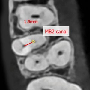 3D ENDO CBCT snimak zuba