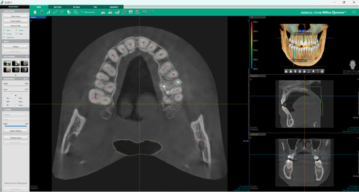 3D CBCT prikaz vilica i umnjaka